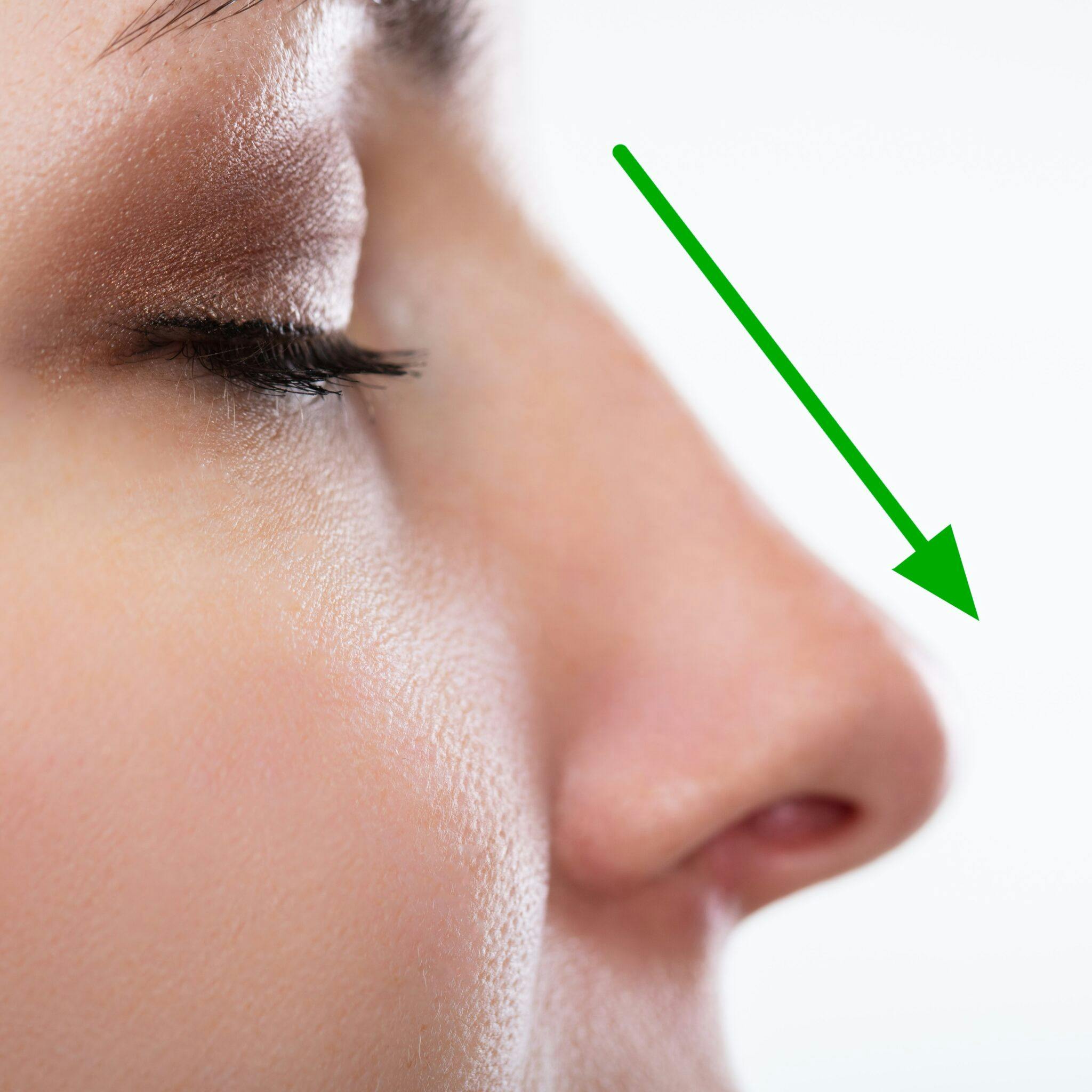 Come rimuovere la gobba dal naso: cosa devi sapere