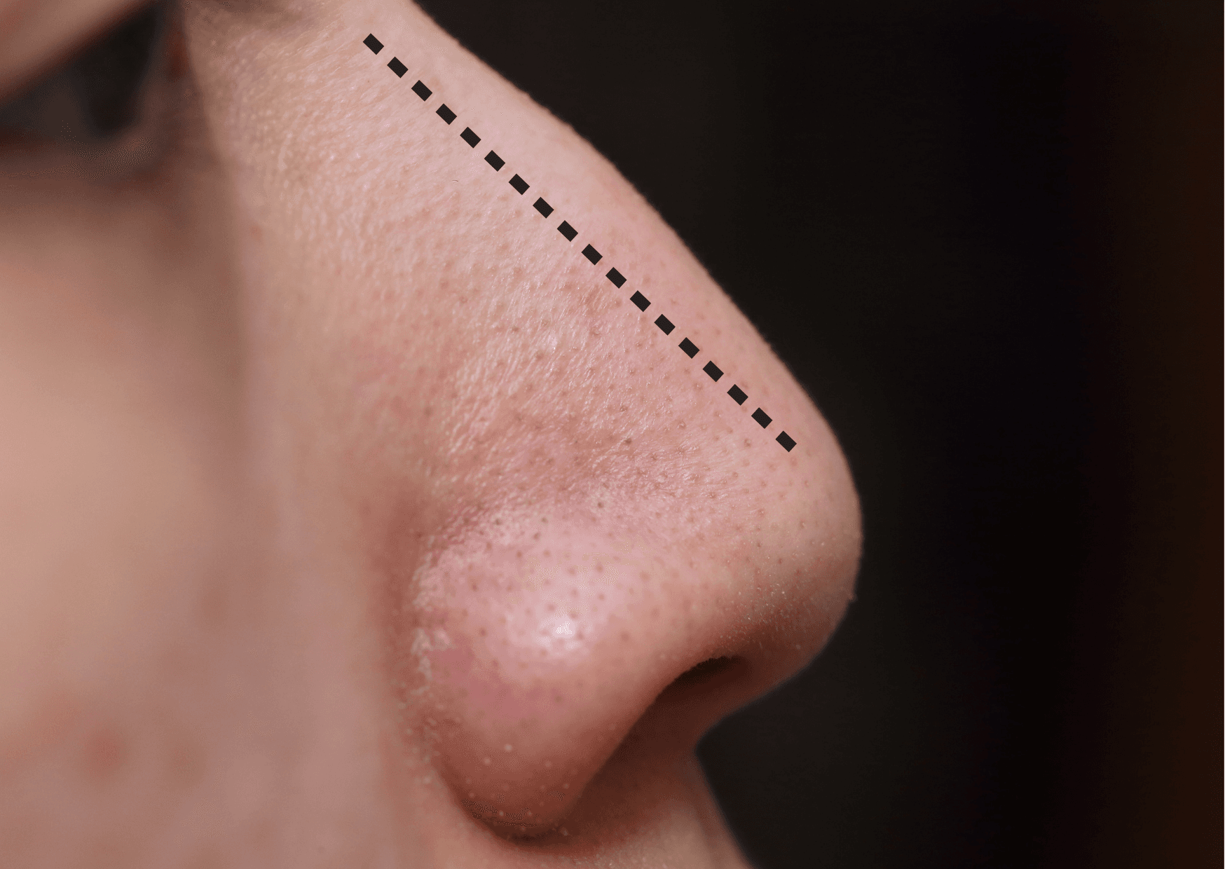 Rinoplastica: differenza tra estetica e funzionale e perché conta il chirurgo