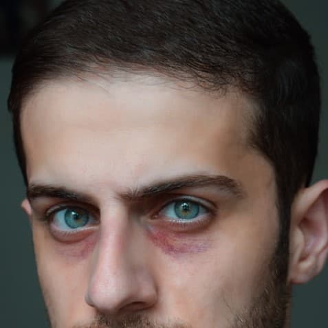 Lividi dopo blefaroplastica: i consigli post operatori