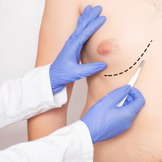 Come diminuire il Seno in un Uomo? I giusti rimedi