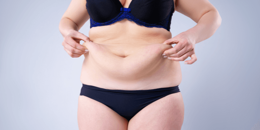Risultato naturale Intervento di Post Obesità