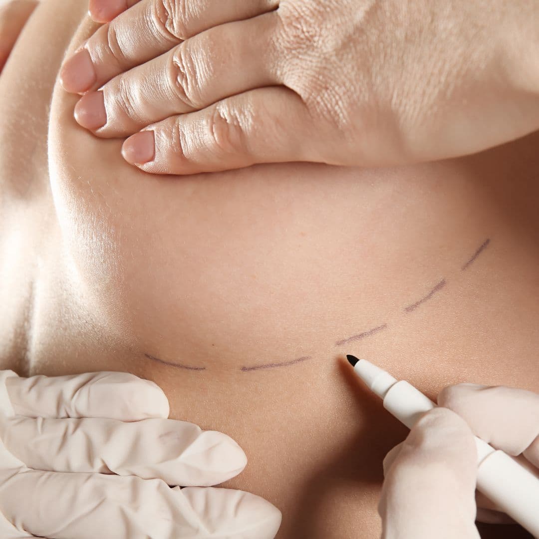 Mastopessi senza cicatrici: i segreti della tecnica scarless