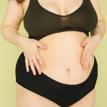 Rischi dell'addominoplastica: quale verità?