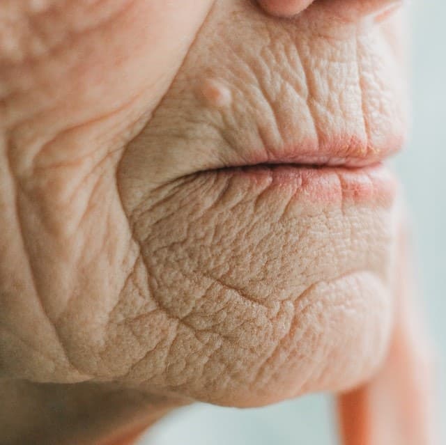 Rughe intorno alla bocca: consigli su come eliminarle e prevenirle