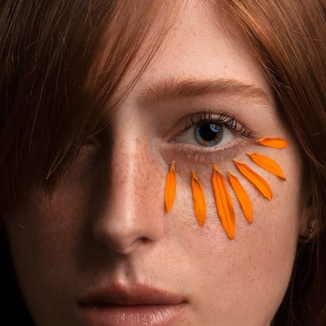 Come eliminare le zampe di gallina con il Botox